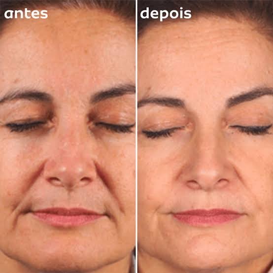 Aparelho rejuvenescedor: anti rugas e anti sinais.